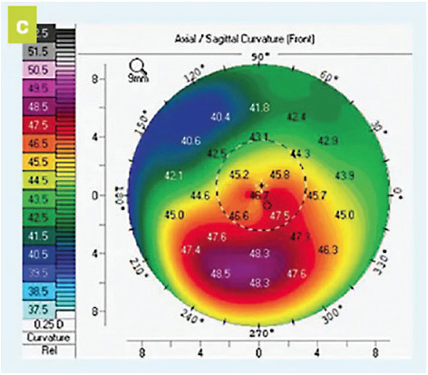 Figure 3. This sagittal map shows keratoconus. IMAGE COURTESY OF DIANNA E. GRAVES, COMT